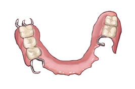 部分入れ歯