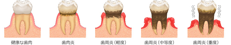 歯周病